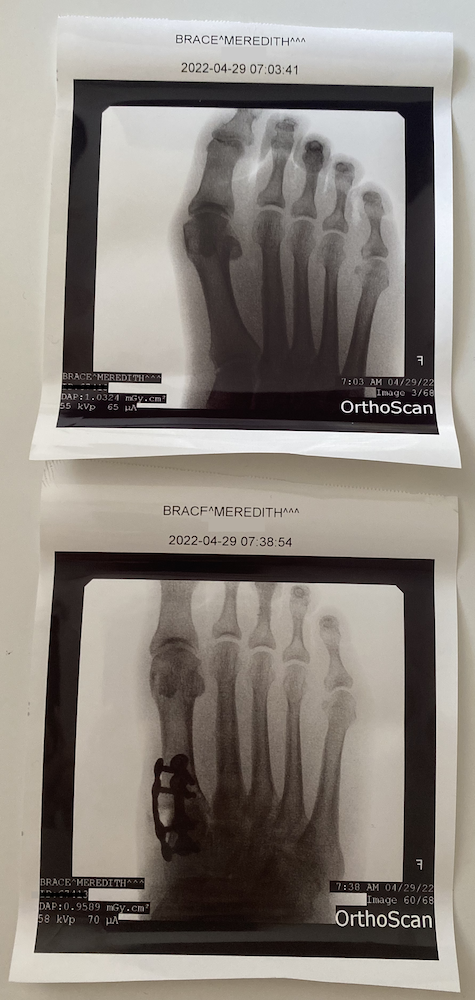 Before and after of lapiplasty (bunion correction) surgery. First picture shows a curved big toe bone, second picture shows a straightened bone with metal plates near the ankle.